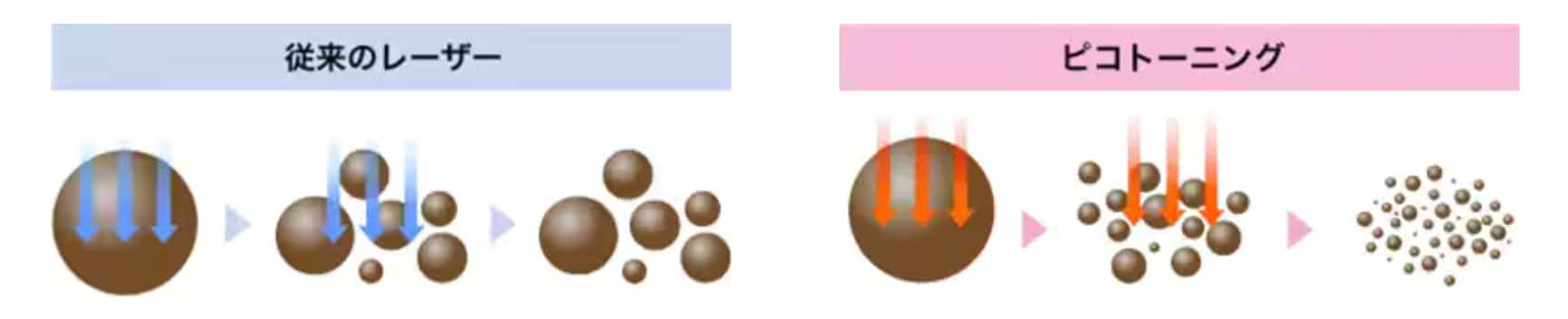 従来のレーザー治療との違い