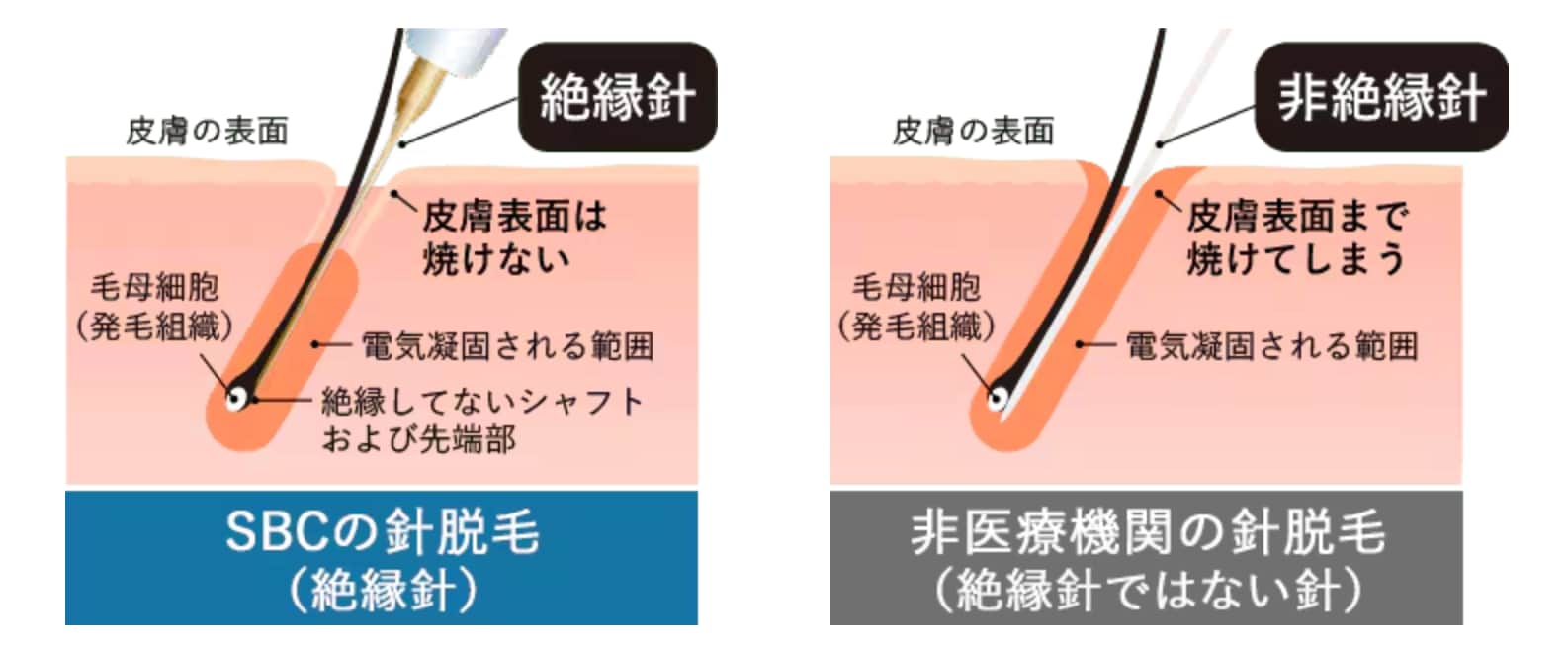 皮膚へのダメージを抑える[ 絶縁針 ]を採用<br />
