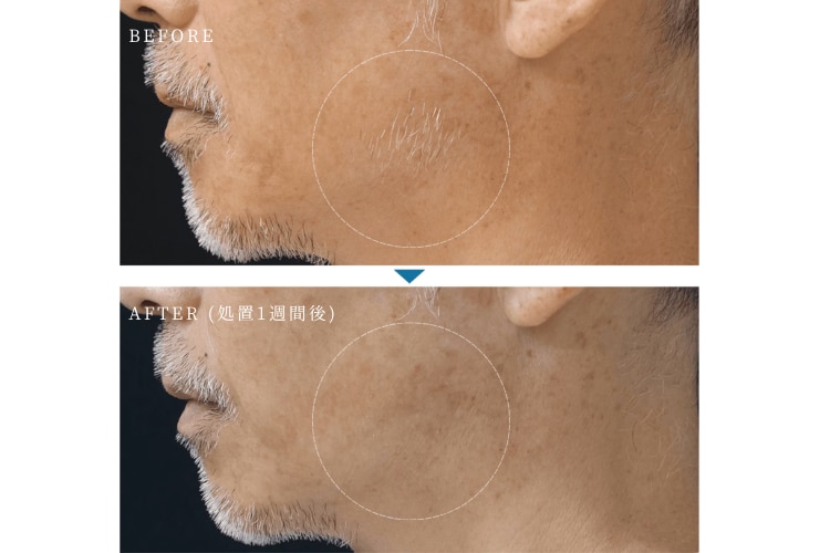 肌の色に関係なく、白髪や産毛も効果あり<br />
