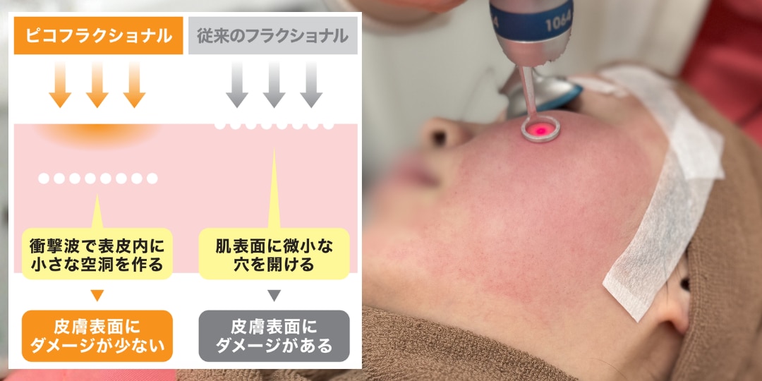ニキビ跡や毛穴にアプローチするピコフラクショナル