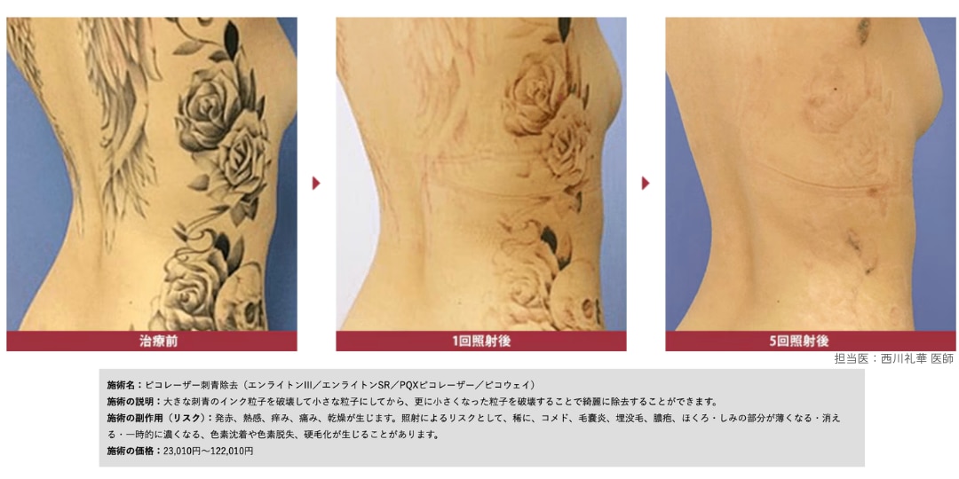 諦めていたタトゥー・刺青除去