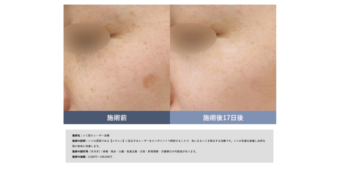 ピンポイントでシミを撃退するピコスポット