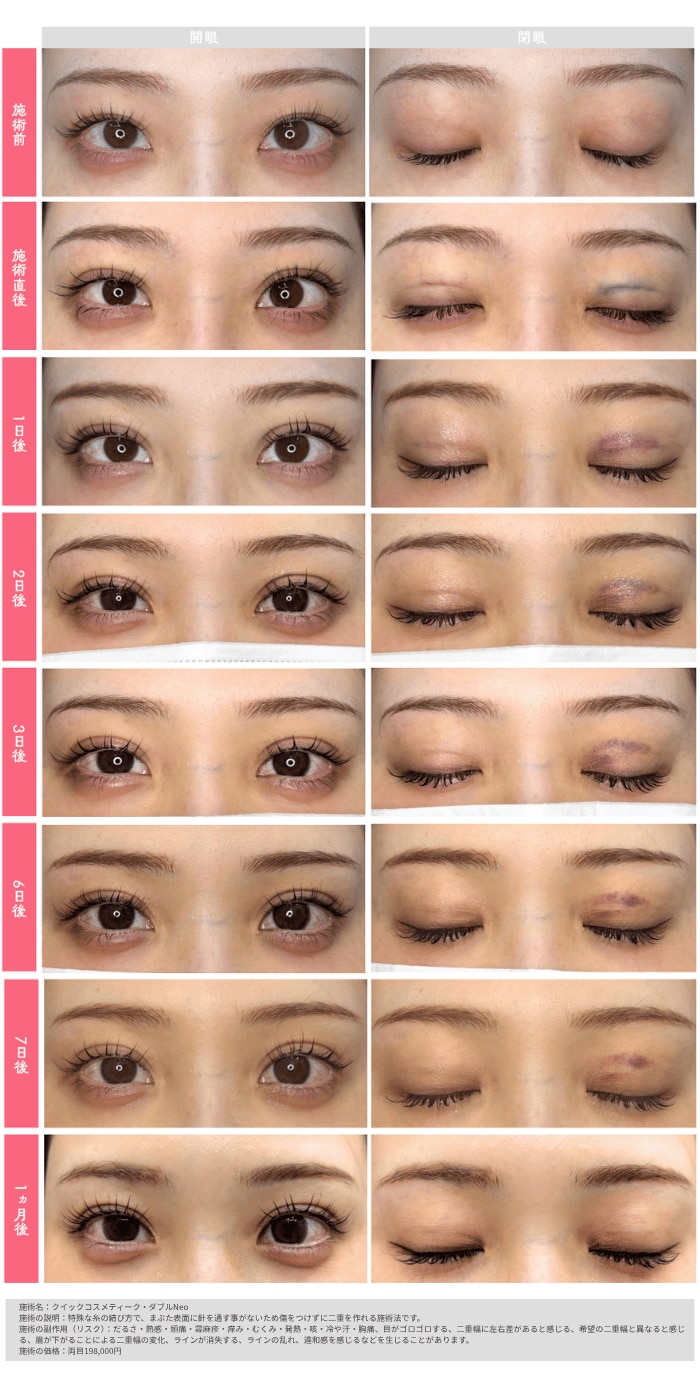 一般的な埋没法の腫れが落ち着くまでの経過