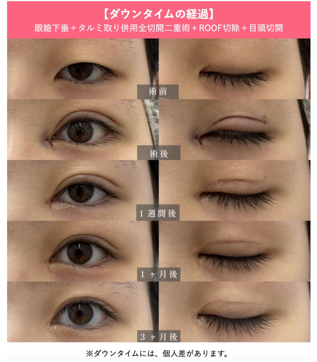 切開法におけるダウンタイムの重要性