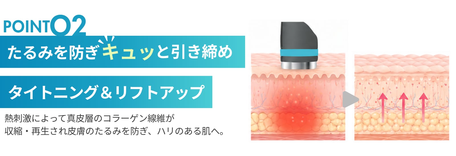 たるみを防いでキュッと引き締め（タイトニング・リフトアップ）