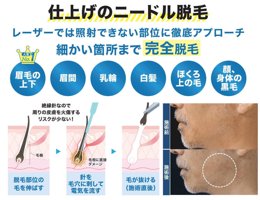 レーザーが照射できない部位にニードル脱毛( 針脱毛 )