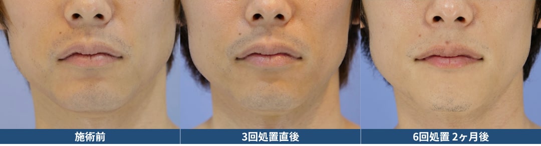 6回でツルツルになりますか？