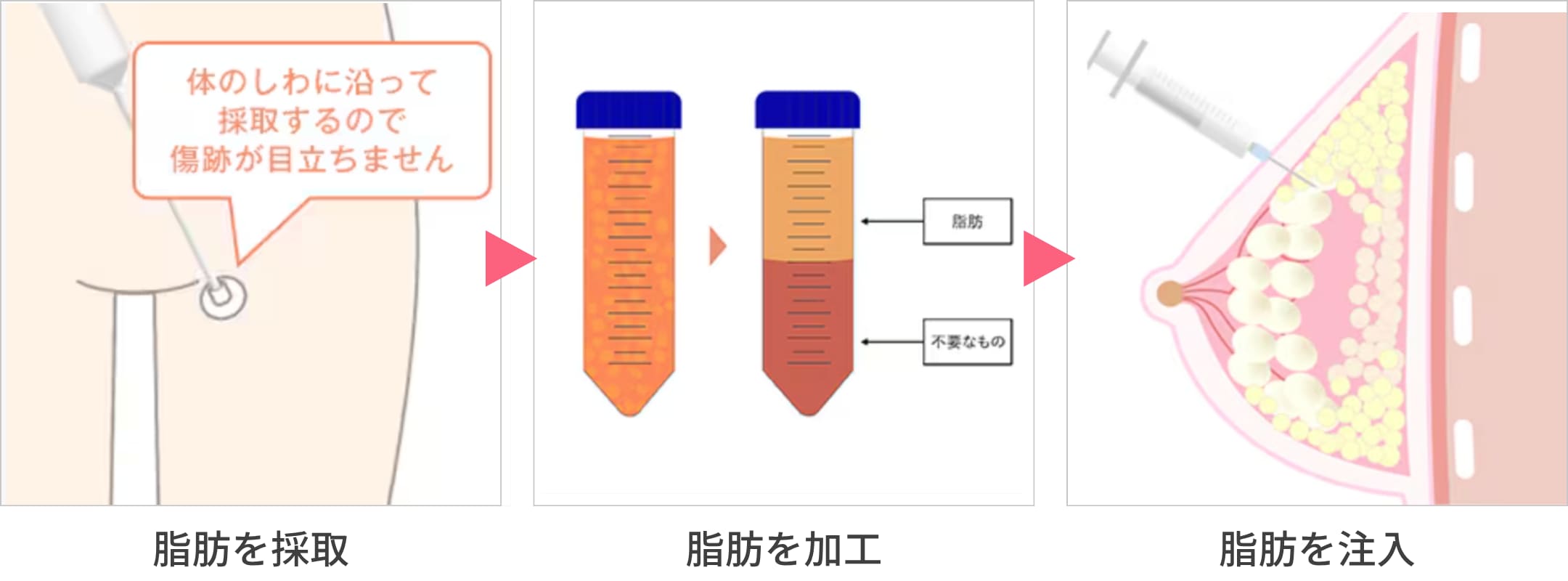 全切開二重術