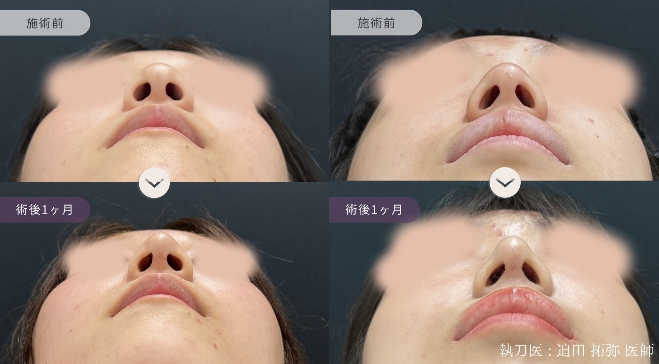 症例写真 Before After