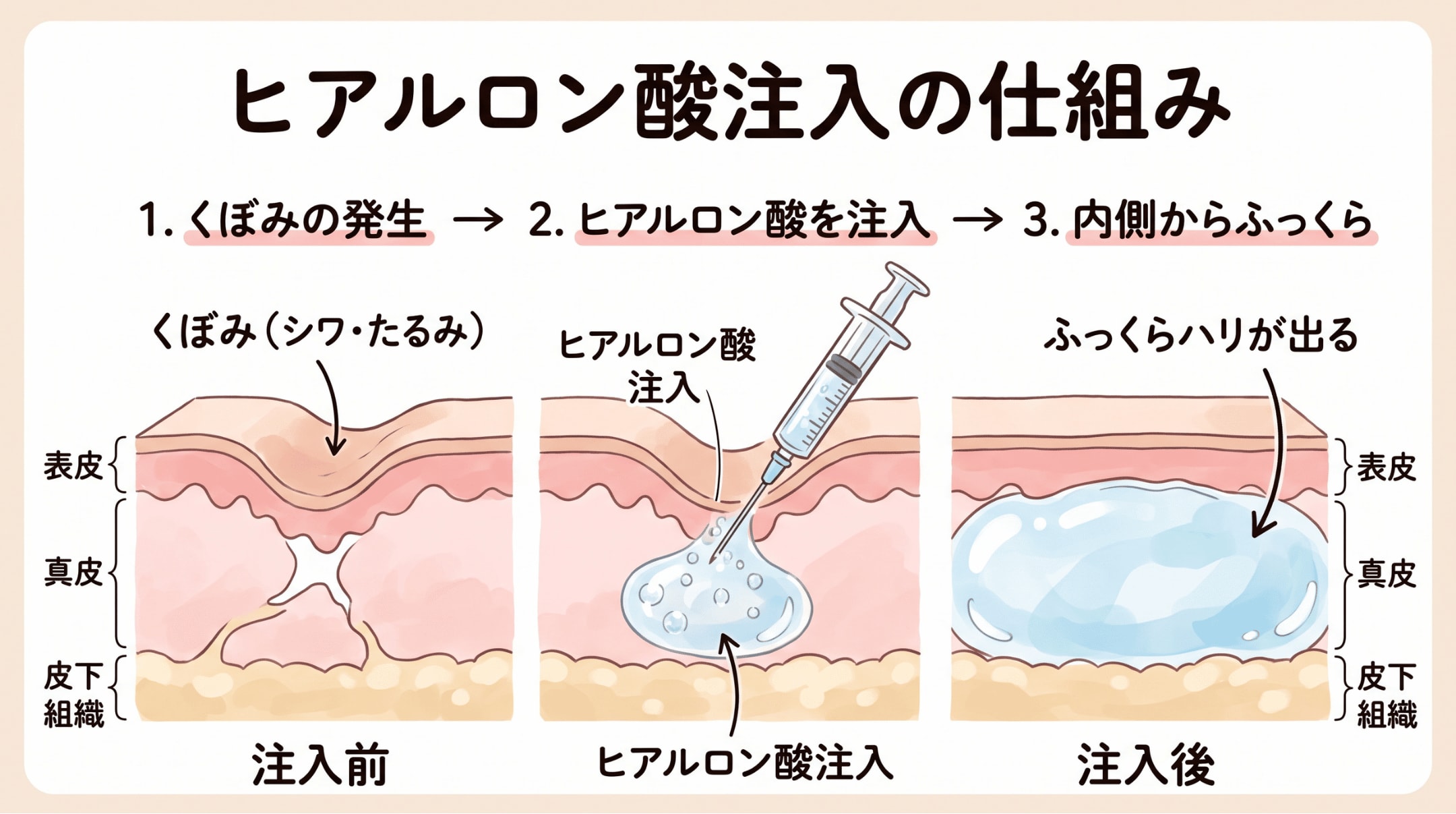 ヒアルロン酸注入