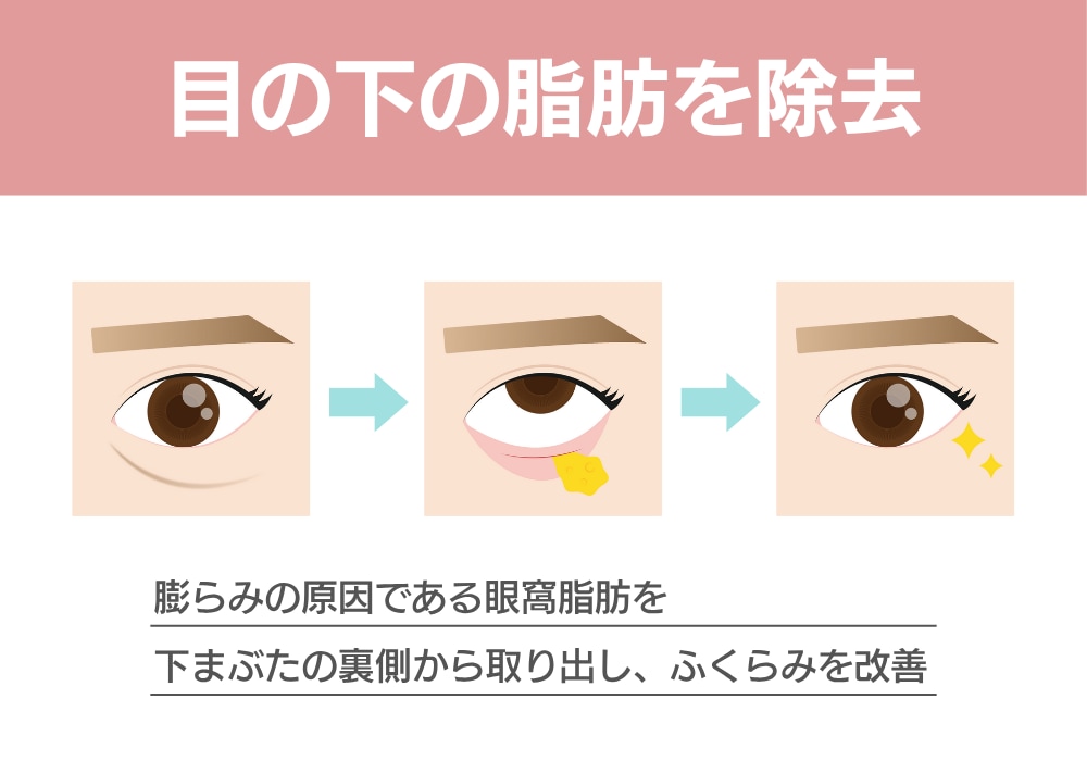 目の下の脂肪を除去