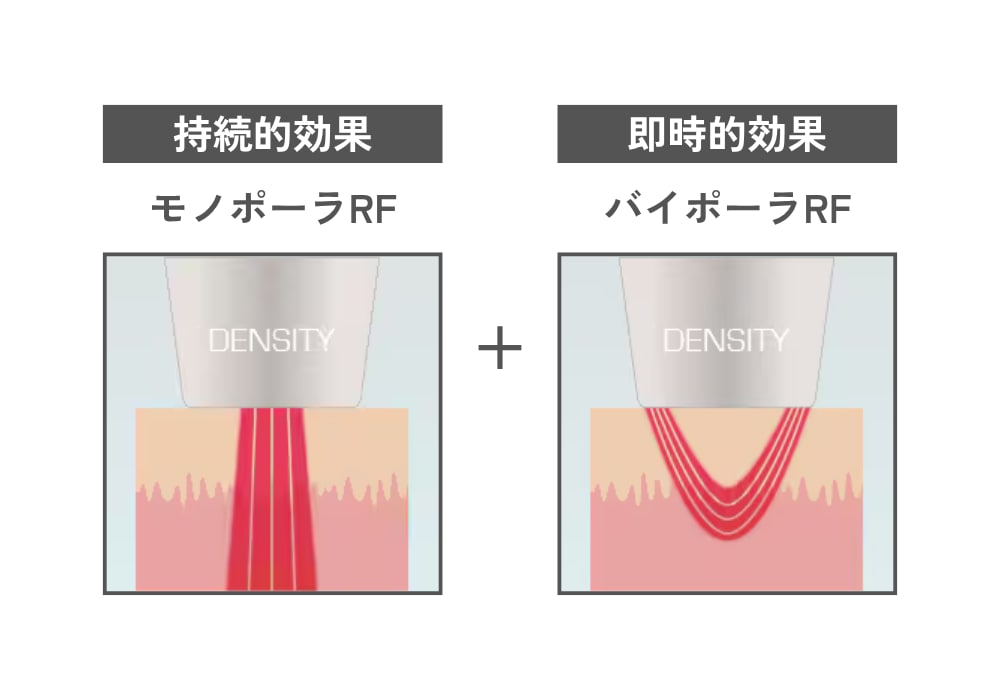 モノポーラ+バイポーラのモノバイ技術