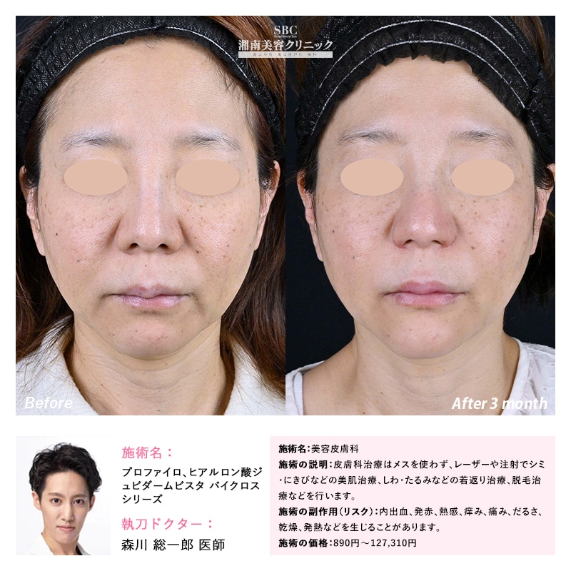 ほうれい線のBefore・After