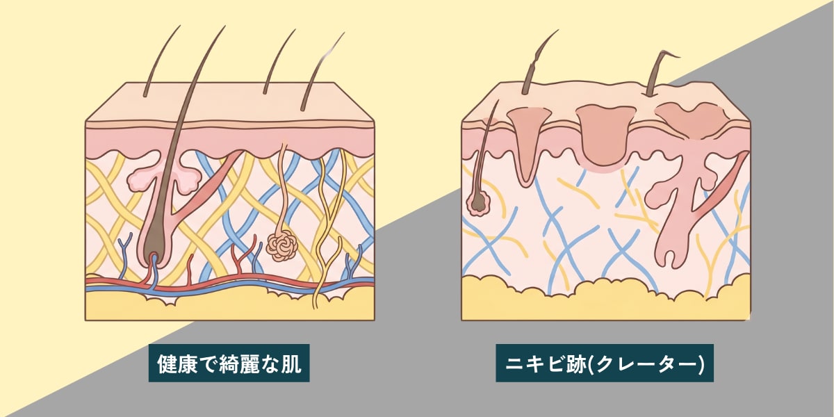 自己ケアでニキビ跡・毛穴が戻らない理由