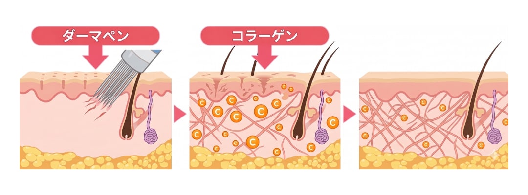 極細の針で肌に微細な刺激を与える仕組み
