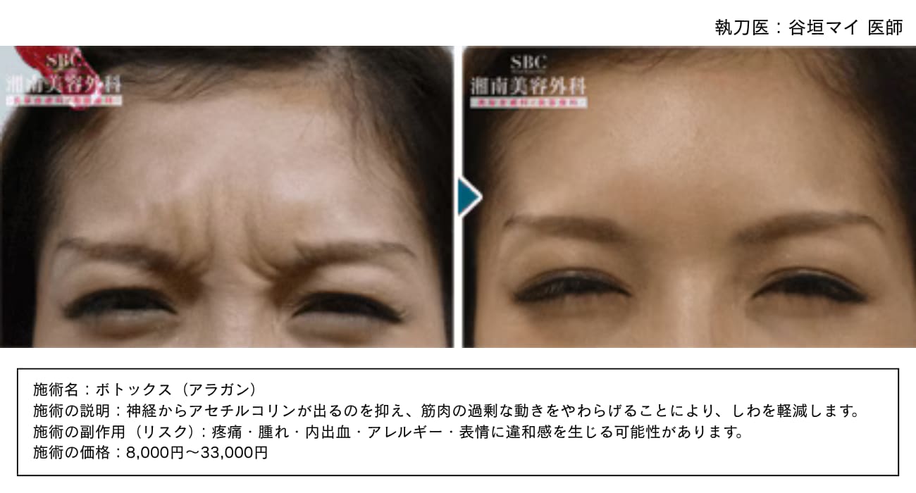 眉間のシワ（縦ジワ・印象改善）