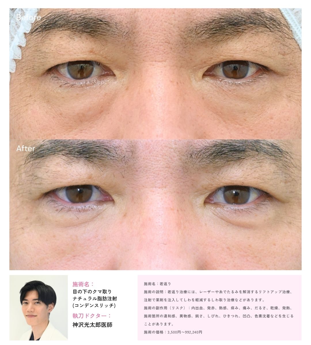 目の下のクマ取り(脱脂)＋ナチュラル脂肪注射(コンデンスリッチ)
