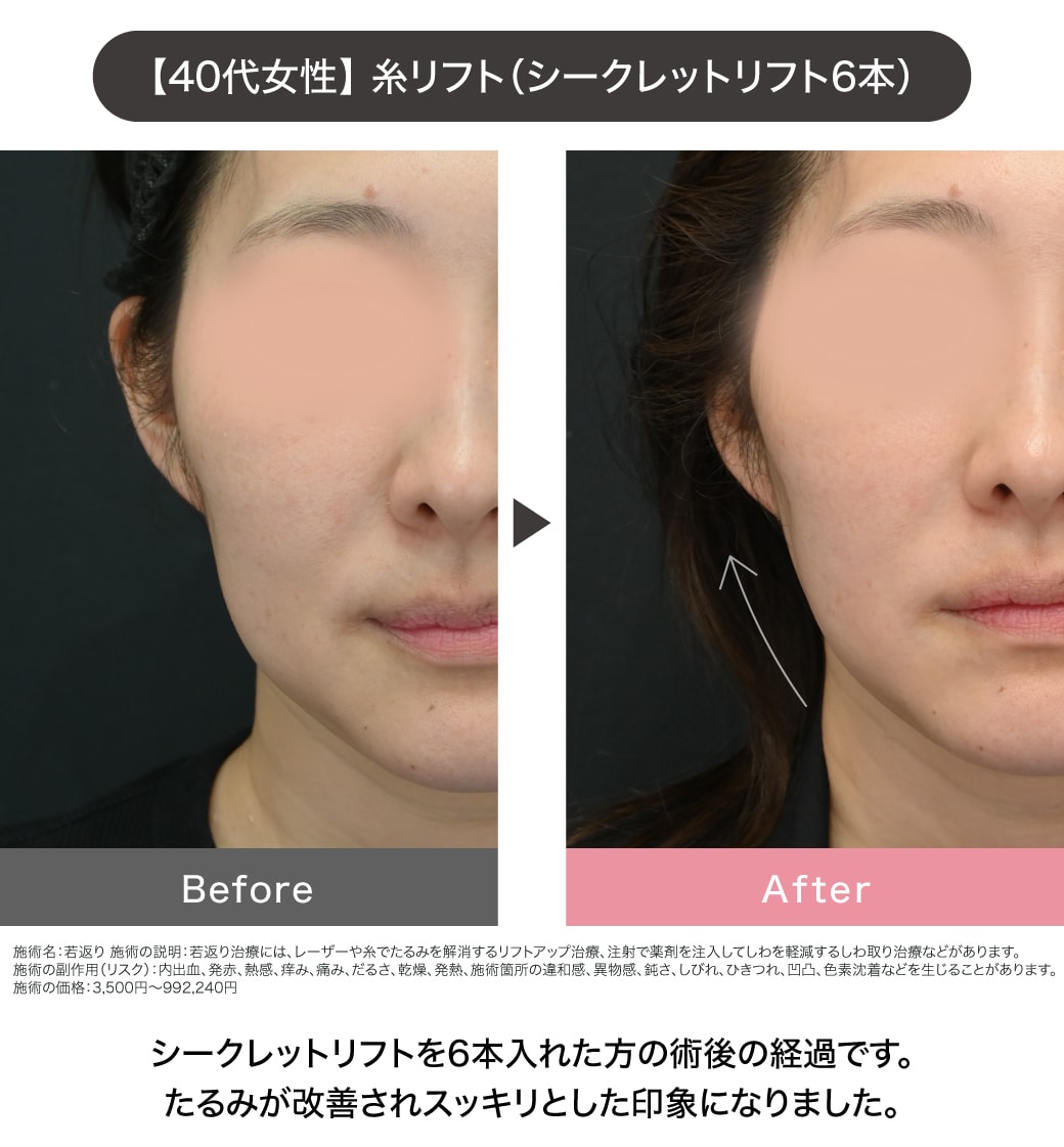 糸リフトの症例写真①