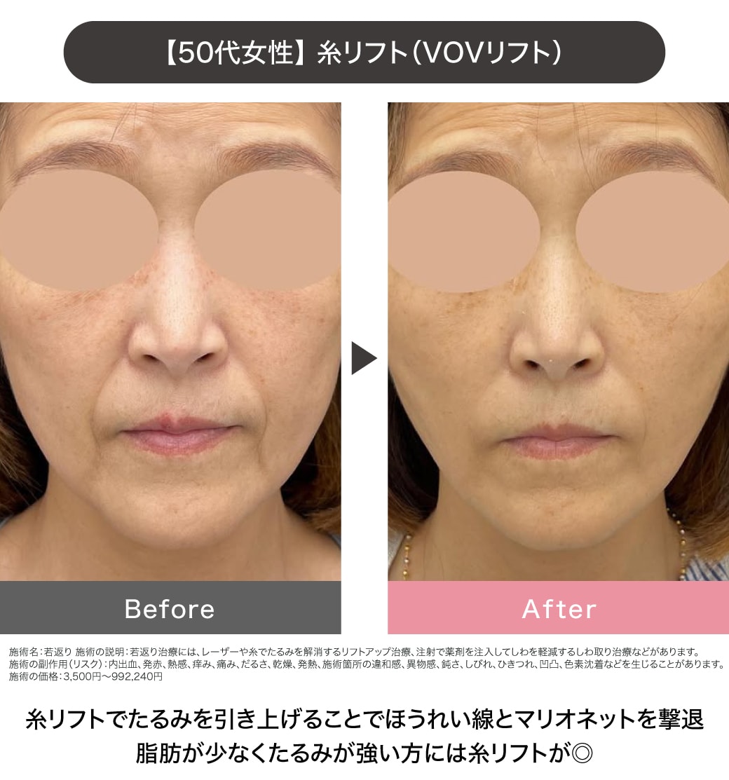 糸リフトの症例写真②