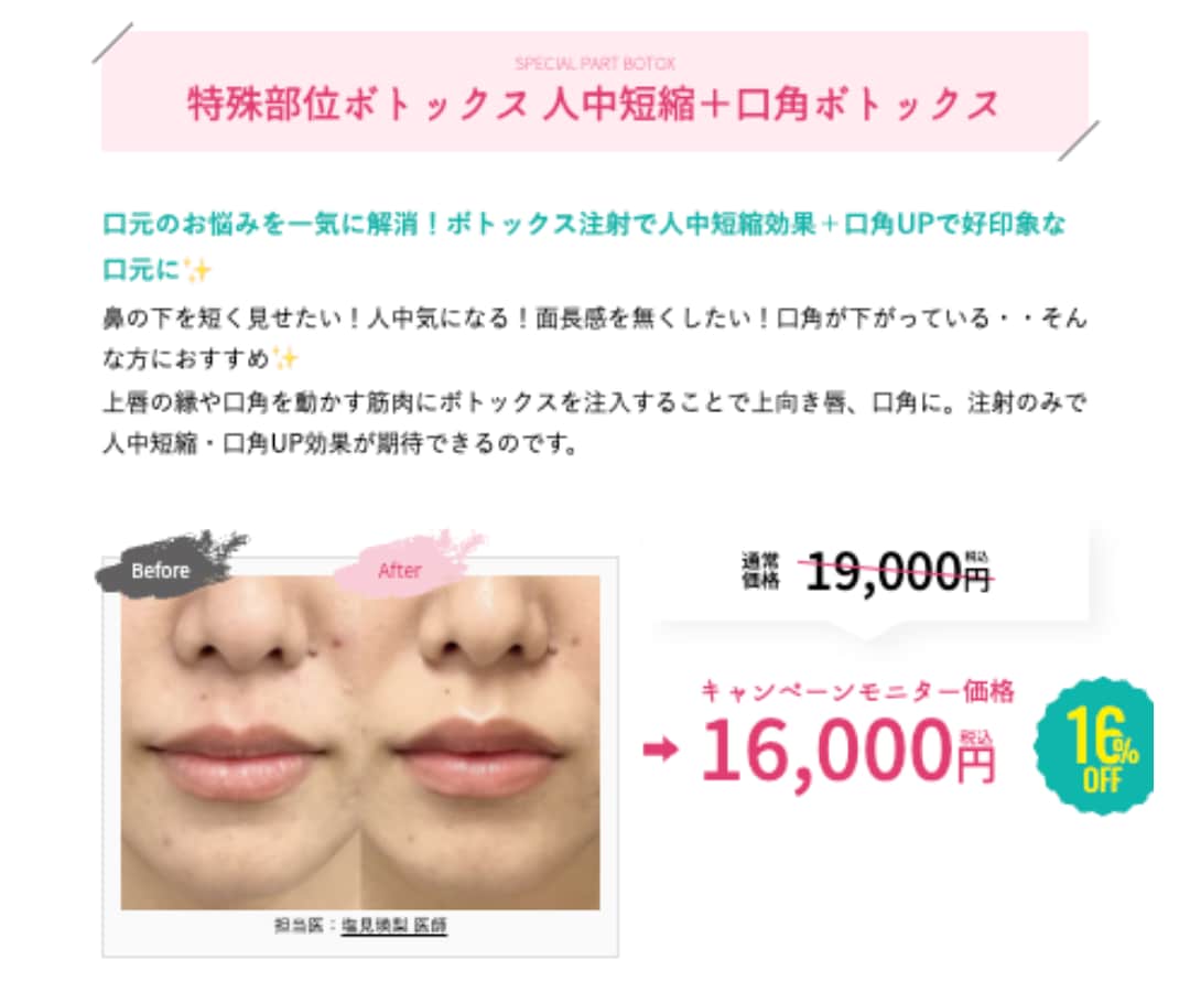 人中短縮ボトックス+口角ボトックス