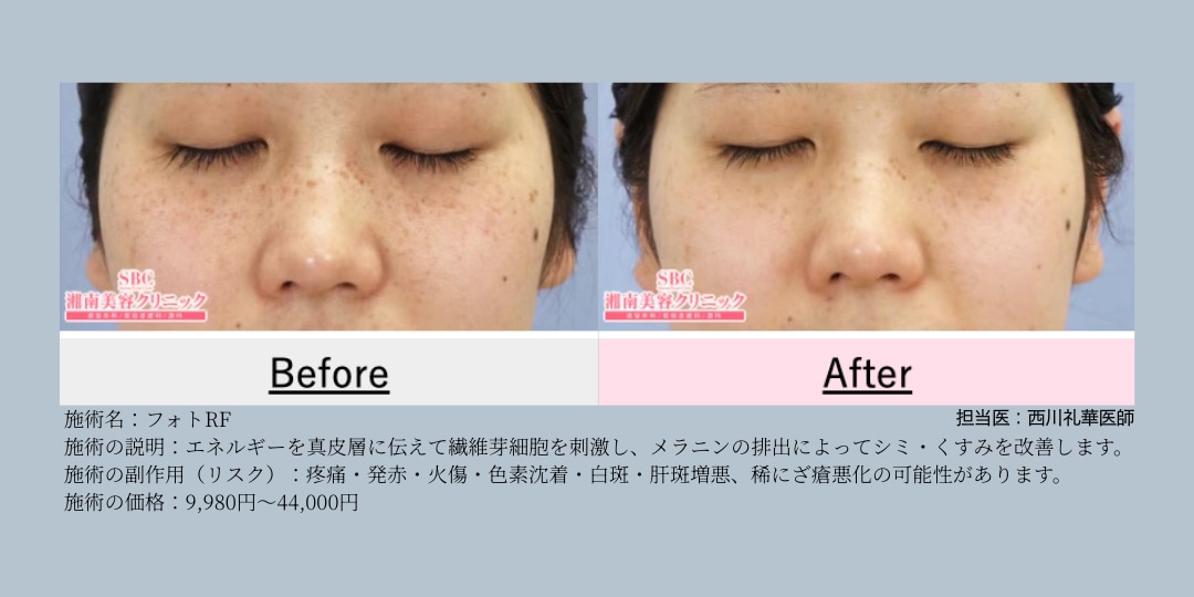 フォトRF の症例写真