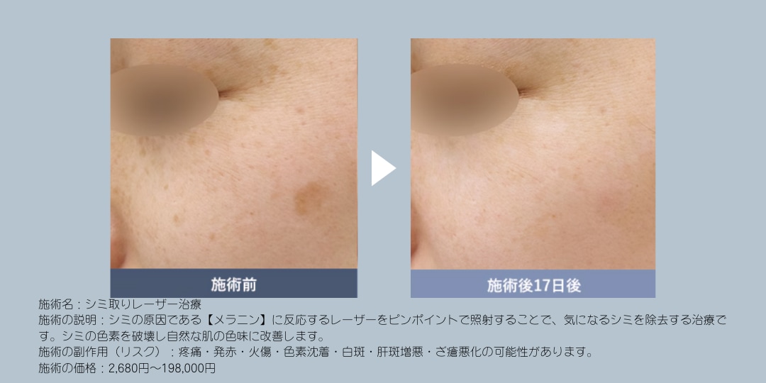 シミ取りレーザーの症例写真はこちら