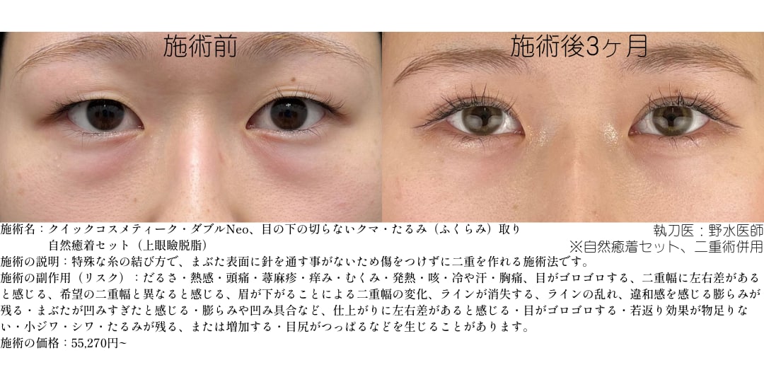 裏ハムラ法