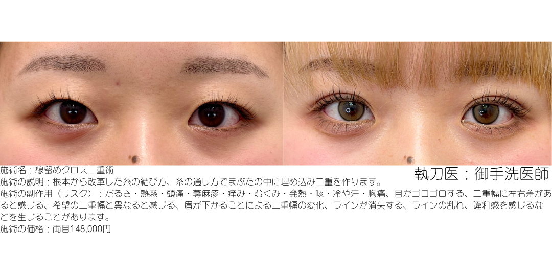 線留めクロス二重術