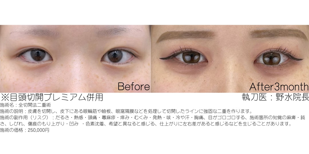 全切開二重術