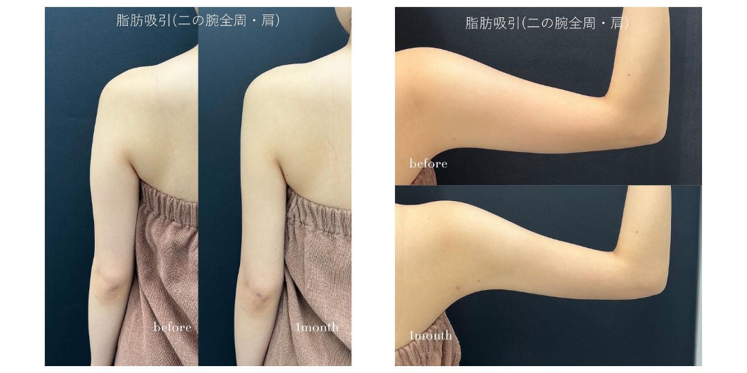 スッキリした華奢な二の腕に