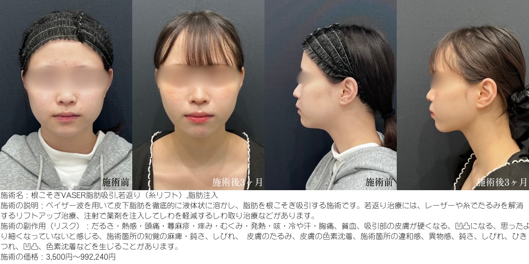 1,VASER脂肪吸引　ほほ＋あご下