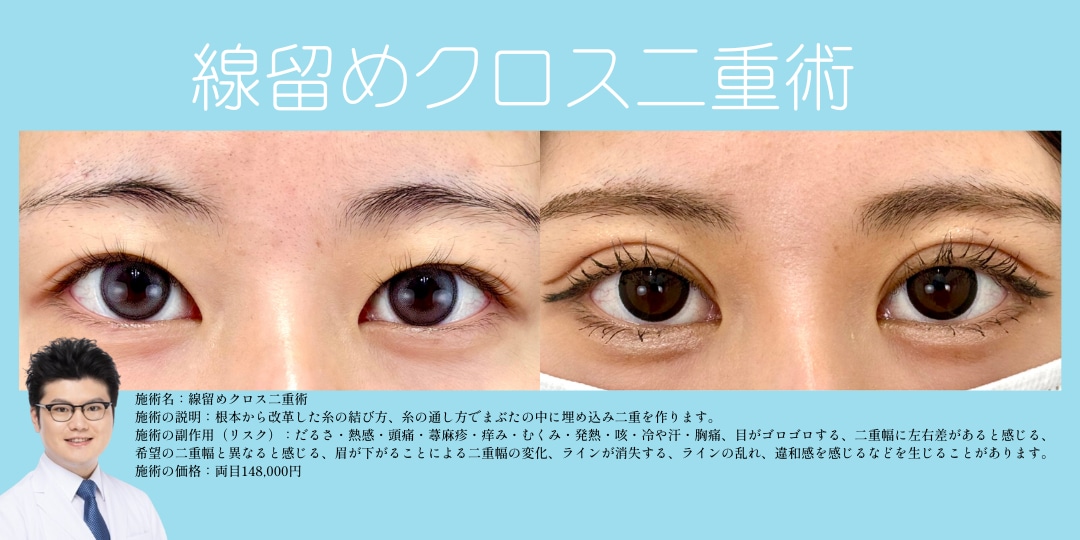 線留めクロス二重術