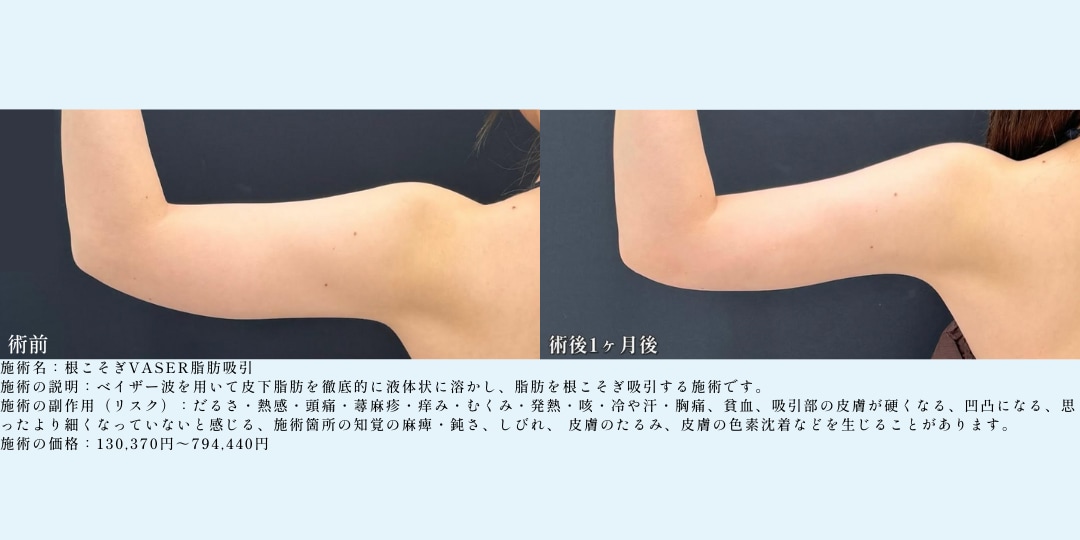 １、脂肪吸引