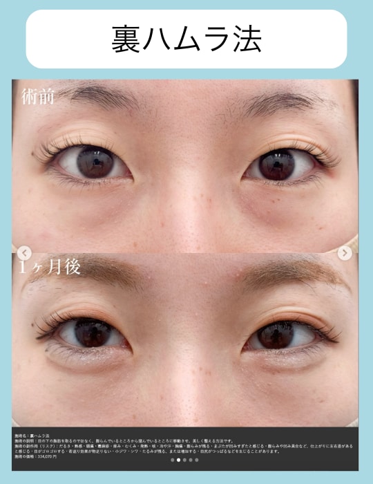 裏ハムラ+脂肪注入