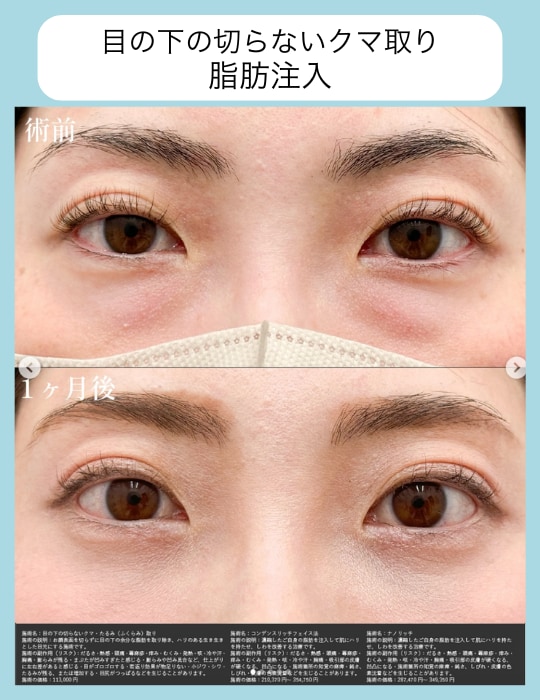 目の下の切らないクマ・たるみ(ふくらみ)取り+脂肪注入