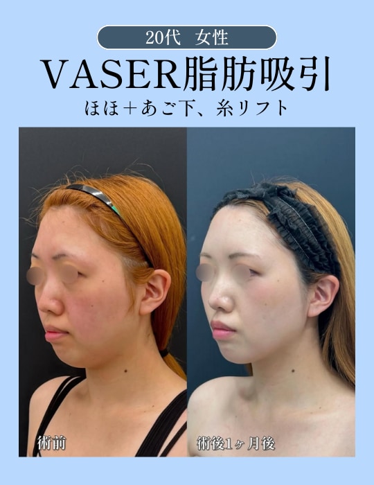 📷脂肪吸引の症例写真をご覧ください📷