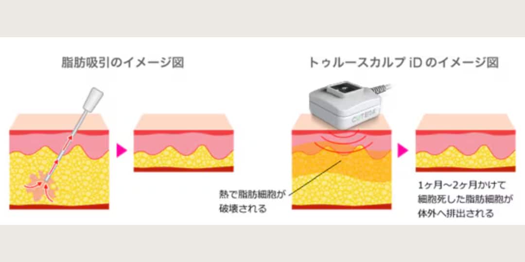 脂肪吸引との違いは何ですか？