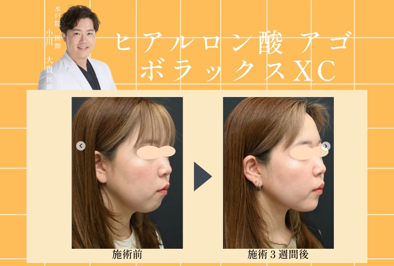 ヒアルロン酸  ボラックスXC（あご、フェイスラインのみ）