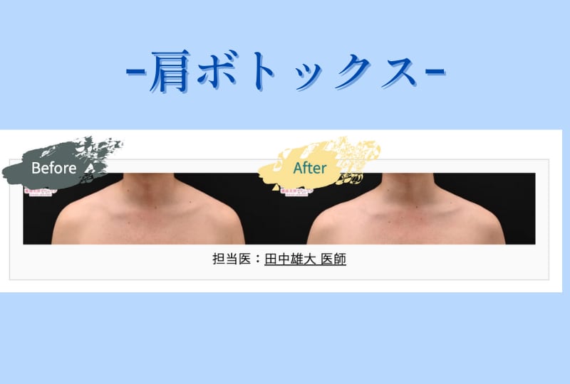 ボトックス（肩）