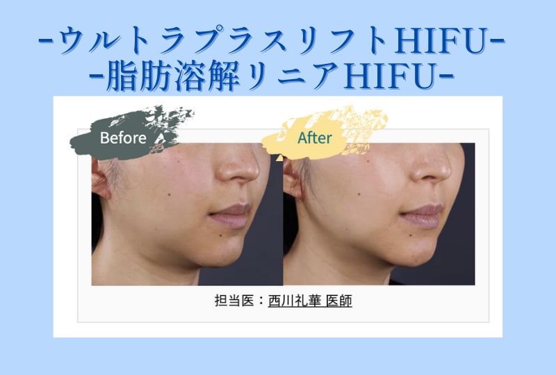 ウルトラリフトプラスHIFU＋新脂肪溶解リニアHIFU