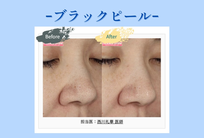 ブラックピール　