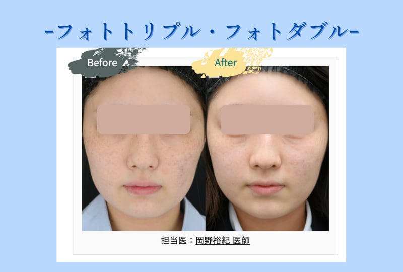 フォトトリプル・フォトダブル（ステラM 22）