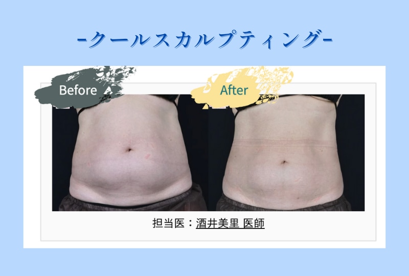 クールスカルプティング