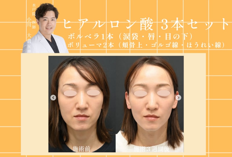 ヒアルロン酸3本セット