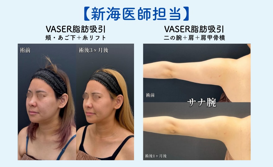 全ての脂肪吸引施術が15%OFFに