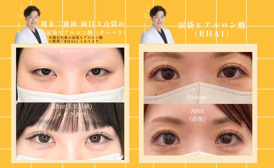 週末二重術✖️涙袋ヒアルロン酸(RHA1)が”期間限定”でお得な価格に❣️