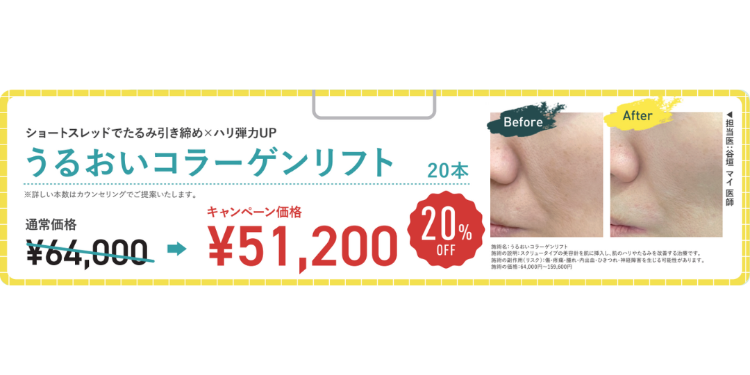 口横のぷにっとしたたるみを改善するなら『うるおいコラーゲンリフト』