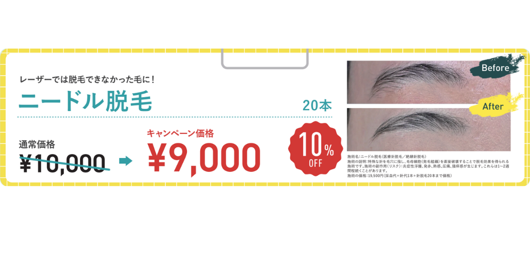 意外とみられている眉下の毛・医療脱毛で打てなかったところに『ニードル脱毛』