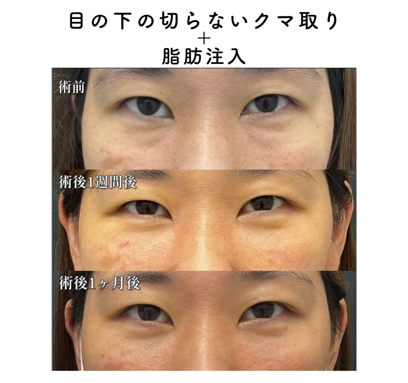 目の下の切らないクマ取り