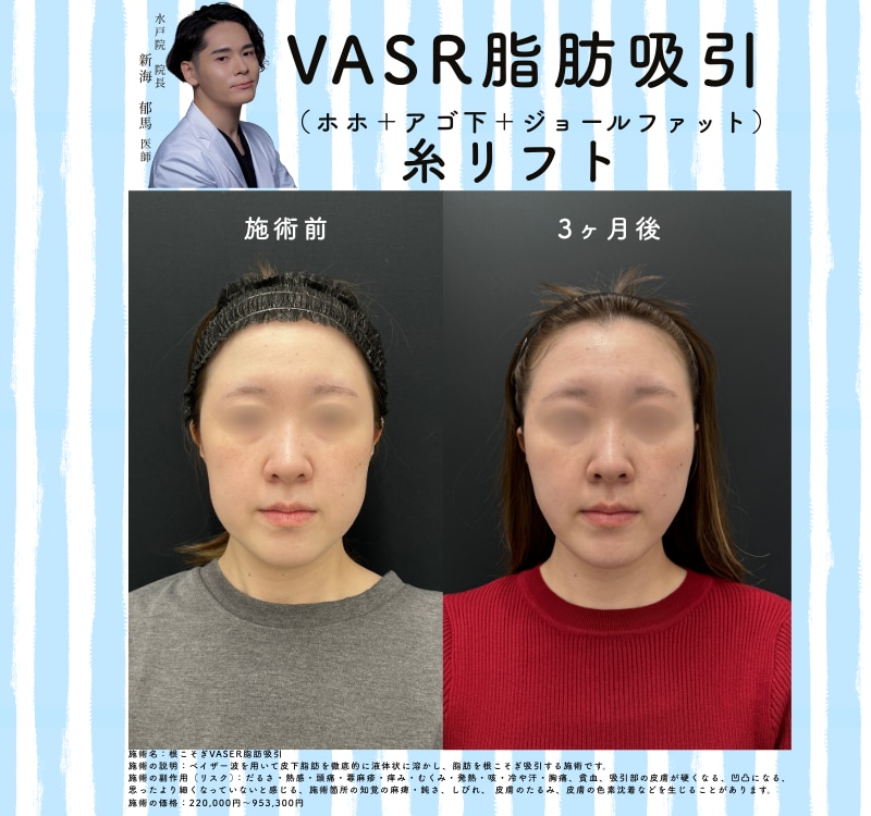 VASER脂肪吸引